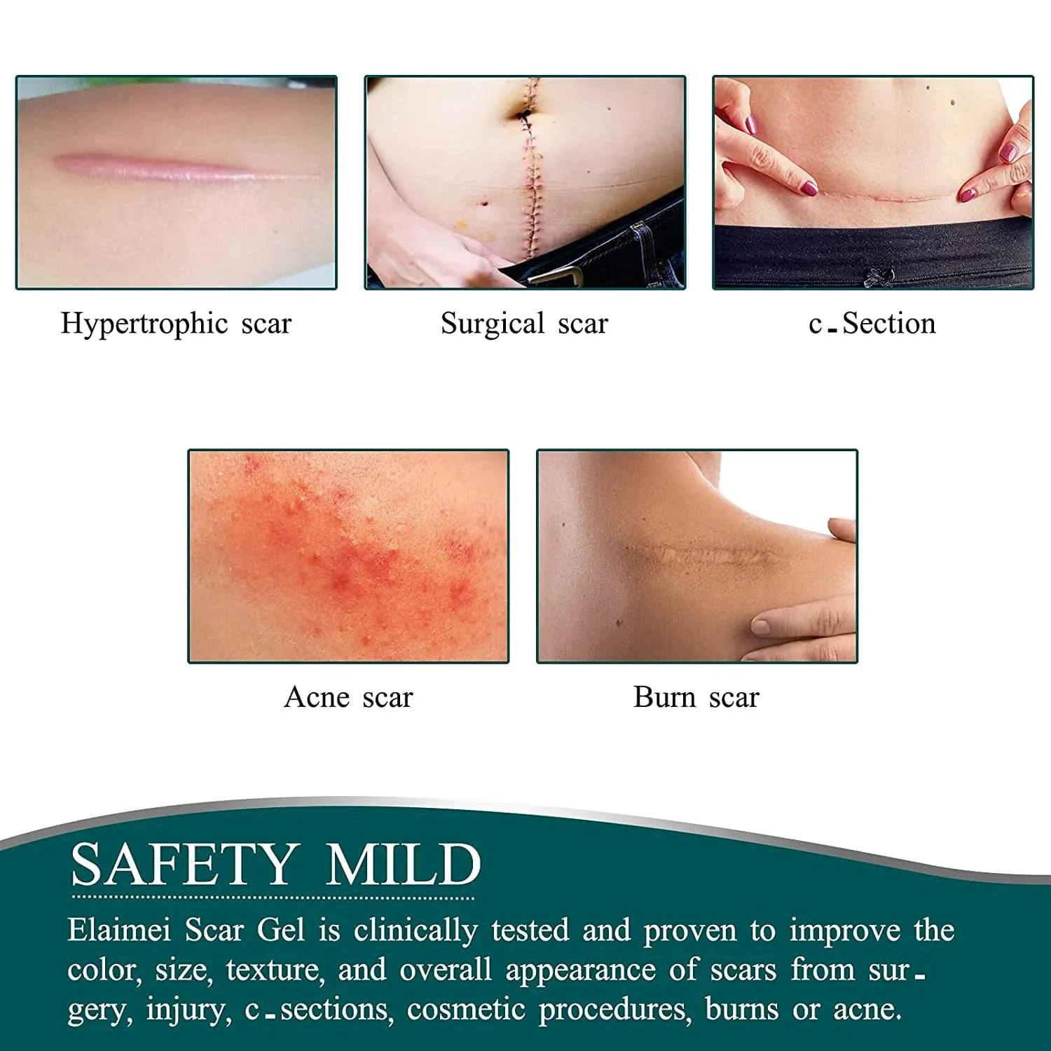Dermoxy™️ Scar Removal Tape (Pack of 2)